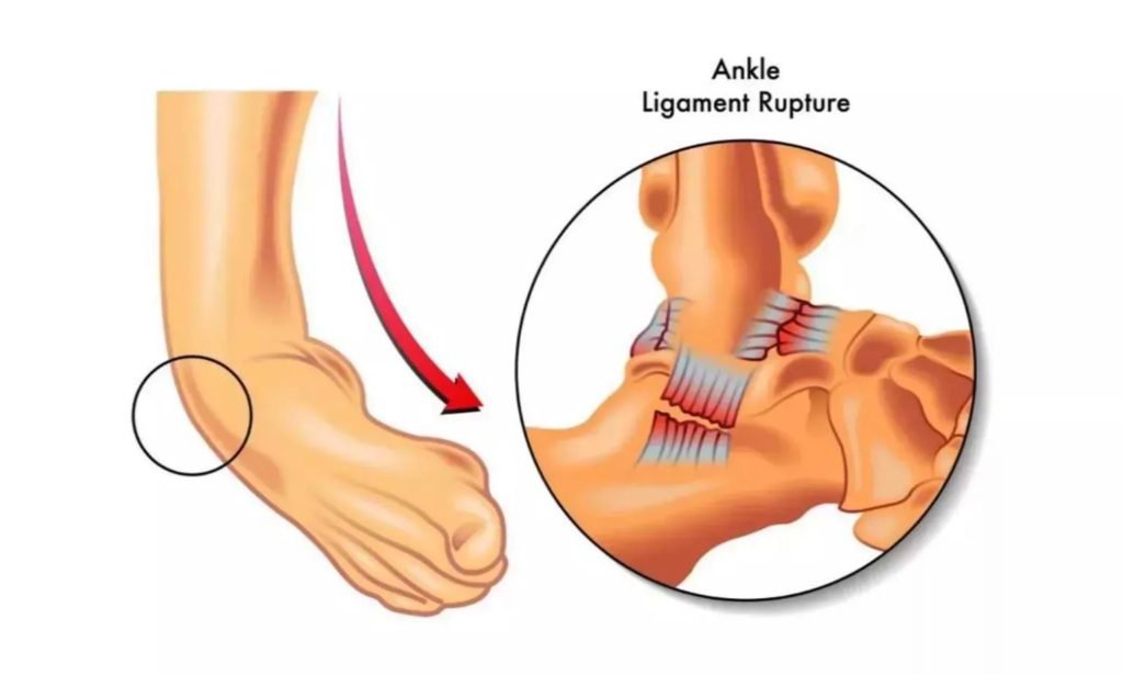 HAVE YOU LOST FAITH IN YOUR ANKLE? INSIGHTS INTO ADULT AND CHILDREN ...
